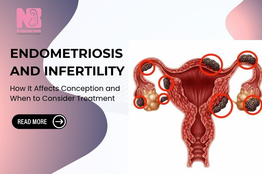 Endometriosis